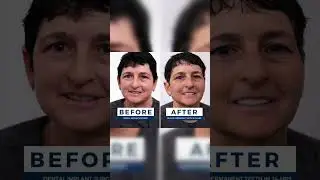 Awesome Smile Transformation In Just 24 HOURS! 😎🦷 