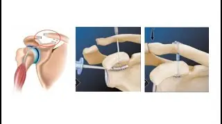 AcromioClavicular Joint Reconstruction: M Mulcahey MD