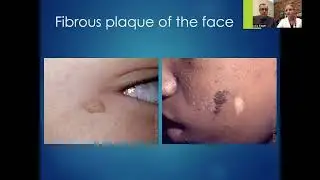 Dermatologic considerations in Tuberous Sclerosis Complex by Dr. Grevelink and Dr. Siegel
