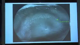 AIOC2022 - IC237 - Is Ultra Wide Field Imaging in Retinal disorders here to stay or just a ...