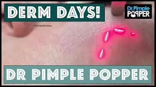 Derm Days with Dr. Pimple Popper!