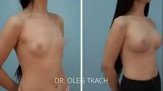 Маммопластика Украина | Увеличение груди Киев | Breast augmentation in Kyiv, Ukraine