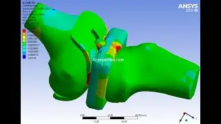 Biomechanics Simulation of Total Knee Replacement or Arthroplasty with Implant - ANSYS WB Explicit