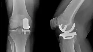 Indications and ContraIndications of Unicompartmental Knee Replacement