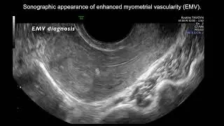 Clinical and ultrasonographic characteristics of pregnancy-related enhanced myometrial vascularity