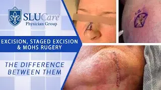 The Difference Between Excision, Staged Excision & Mohs Surgery for removing skin cancer