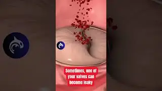 Do you have a leaky Heart Valve? See how it's fixed.🫀 