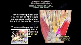 Ganglion cyst  carpal tunnel - Everything You Need To Know - Dr. Nabil Ebraheim