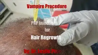 Hair Loss? Try PRP Injections by Dr. Pickens