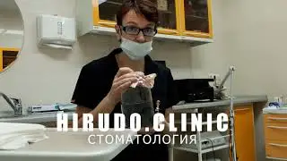 Лечение медицинской пиявкой. Гирудотерапевт в Москве. HirudoTherapy medical leech therapy. Dental