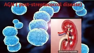 Acute glomerulonephritis | post streptococcal disease