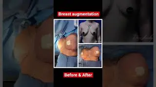 Breast augmentation before and after results with Dr. Thomas T. Jeneby MD