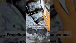 Резорбция грыжи позвоночника L4-L5 в Клинике Ткачева 