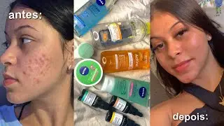 ROTINA DE CUIDADOS COM A MINHA PELE OLEOSA E ACNEICA + PRODUTOS QUE SALVARAM MINHA PELE ✨