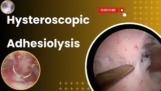 Hysteroscopic Adhesiolysis | Management of Intrauterine Adhesions