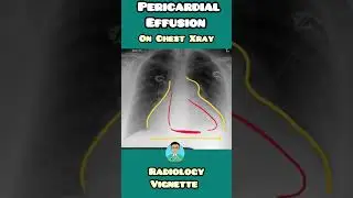 Pericardial Effusion & Water bottle sign for USMLE, NEET PG,  NCLEX,  INICET #healtheducation