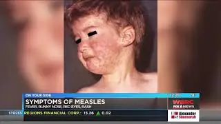 Let's Talk Measles - Signs & Symptoms