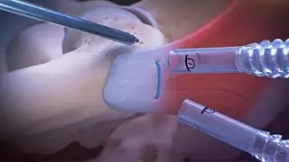 Knotless Compression Bridge Technique for Repair of an Undersurface Tear of the Gluteus Medius