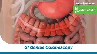 GI Genius Colonoscopy