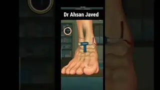 Ankle Fracture Surgery 3D. 