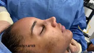 Rhinoplasty For A Wide Nose and Drooping Nasal Tip- South Florida Rhinoplasty Surgery