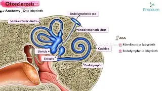 Otosclerosis 👂 : ENT Lectures