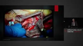 Surgical Repair of Atrial Septal Defects - Mr Simon Moten