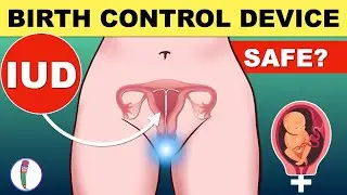 Intrauterine Device (IUD) For Pregnancy Control | IUD Insertion | Birth Control