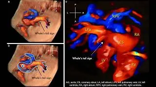 Whale's tail sign in fetus with coronary sinus total anomalous pulmonary venous connection