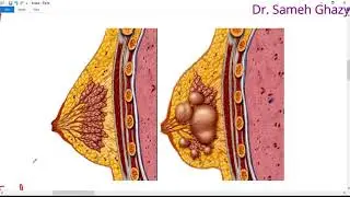 Systemic pathology 66 : Breast 1 ( fibrocystic disease and benign tumors )