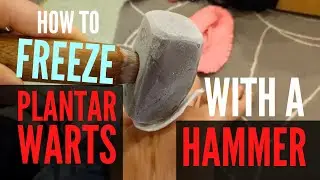 Freeze Plantar Warts DIY at Home for Free