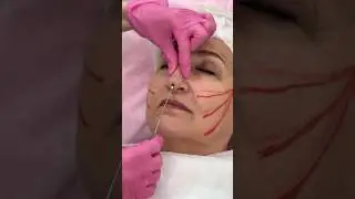 Комплексный подход в омоложении без боли, наркоза и длительной реабилитации🔥