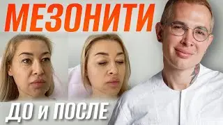 МЕЗОНИТИ ДО и ПОСЛЕ | Ставим Нити COG, мгновенная подтяжка лица #мезонити #подтяжкалица