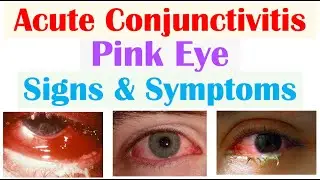 Conjunctivitis Signs & Symptoms (Allergic, Bacterial and Viral) & Why Symptoms Occur