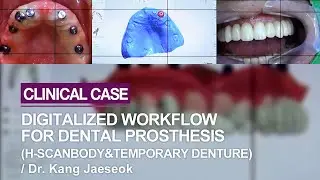 Digital workflow for making a dental prosthesis (process with H-Scanbody)