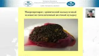 Призенцов А.А. Современная тактика при желчнокаменной болезни