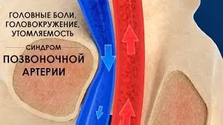 Головные боли, головокружение, утомляемость - синдром позвоночной артерии