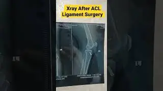 Post ACL Reconstruction Xray | ACL Ligament Screw & Button | लिगामेंट स्क्रू और बटन| #aclsurgery  •