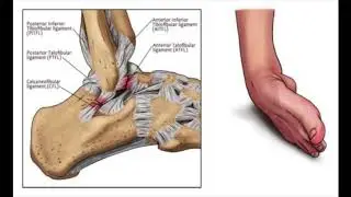 Lateral Ankle Sprains Anatomy Overview