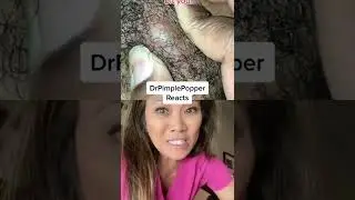 Dr Pimple Popper Needs a SPLASH SCREEN! 