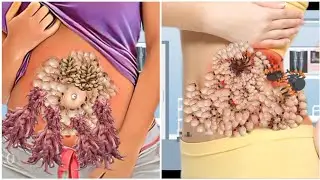 ASMR Remove Maggot  Worm Infected Armpit | Severely Injured Animation