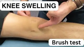 Knee Swelling - The Brush Test