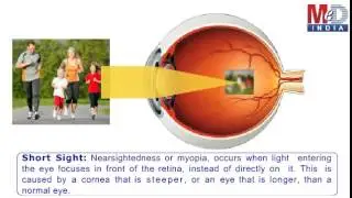 How To Correct Short-Sightedness