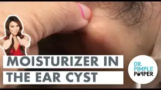 Moisturizer In The Ear Cyst