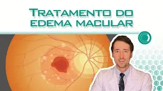 Tratamento do edema macular.