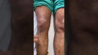 Knee swelling & pain after injury-how to treat /घुटने का मांस फटना और सूजन का इलाज  #shortsindia