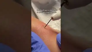 PlexR Mole Removal at DrMediSpa