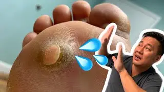 Wart Pops into Doctor's Face!