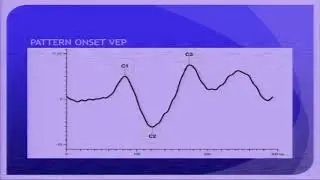 AIOC2018 - GP145 - Topic - Visually evoked potential : Clinical utility ( 5 min )
