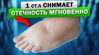 Как старый терапевт спас меня от отёка конечностей! Отек ног - важно